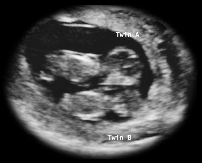 13 Weeks With Twins - Having Some Bleeding and Spotting