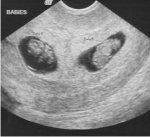 Twin Pregnancy Complications