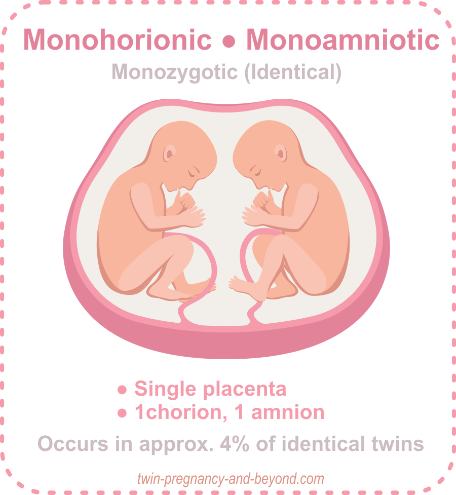 Rare Type of Twins Placentation of Twins How many placentas in a twin 