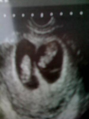 8 Weeks! di/di boy/girl twins ultrasound