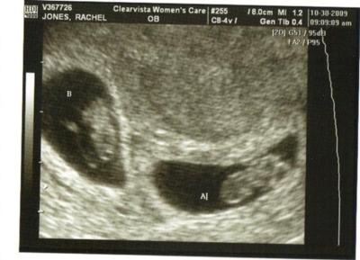 ultrasound twins weeks fraternal twin pregnancy beyond indianapolis indiana