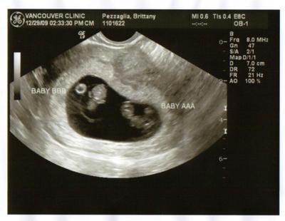 9 weeks pregnant twins ultrasound pictures