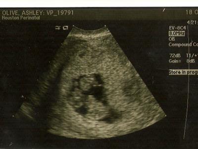 Identical Twins Ultrasound - Ashley Olive
