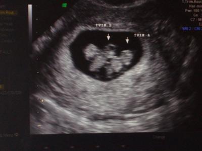 Фото узи 12 недель беременности двойня