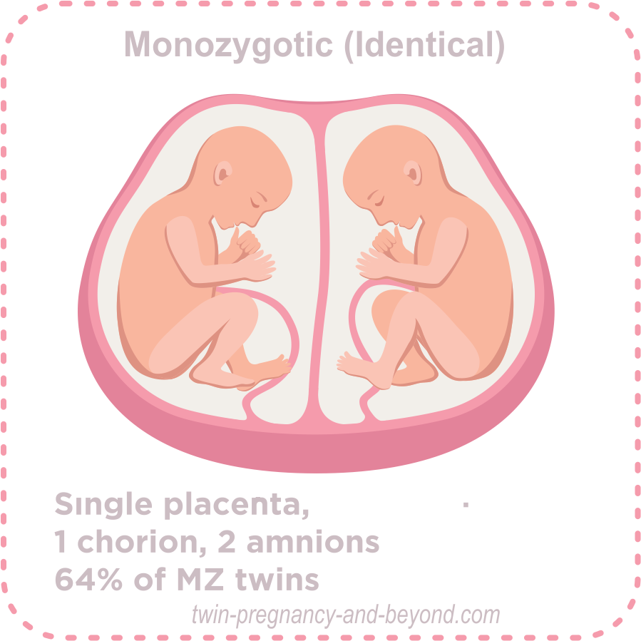 What Is Twin Zygosity Understanding Different Types Of Twinning