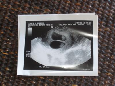 twin ultrasound 8 weeks