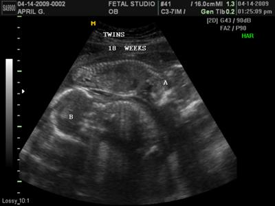 Twin Girls 18 Weeks