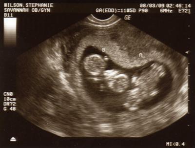 Wilson Twins At 12 Week Ultrasound